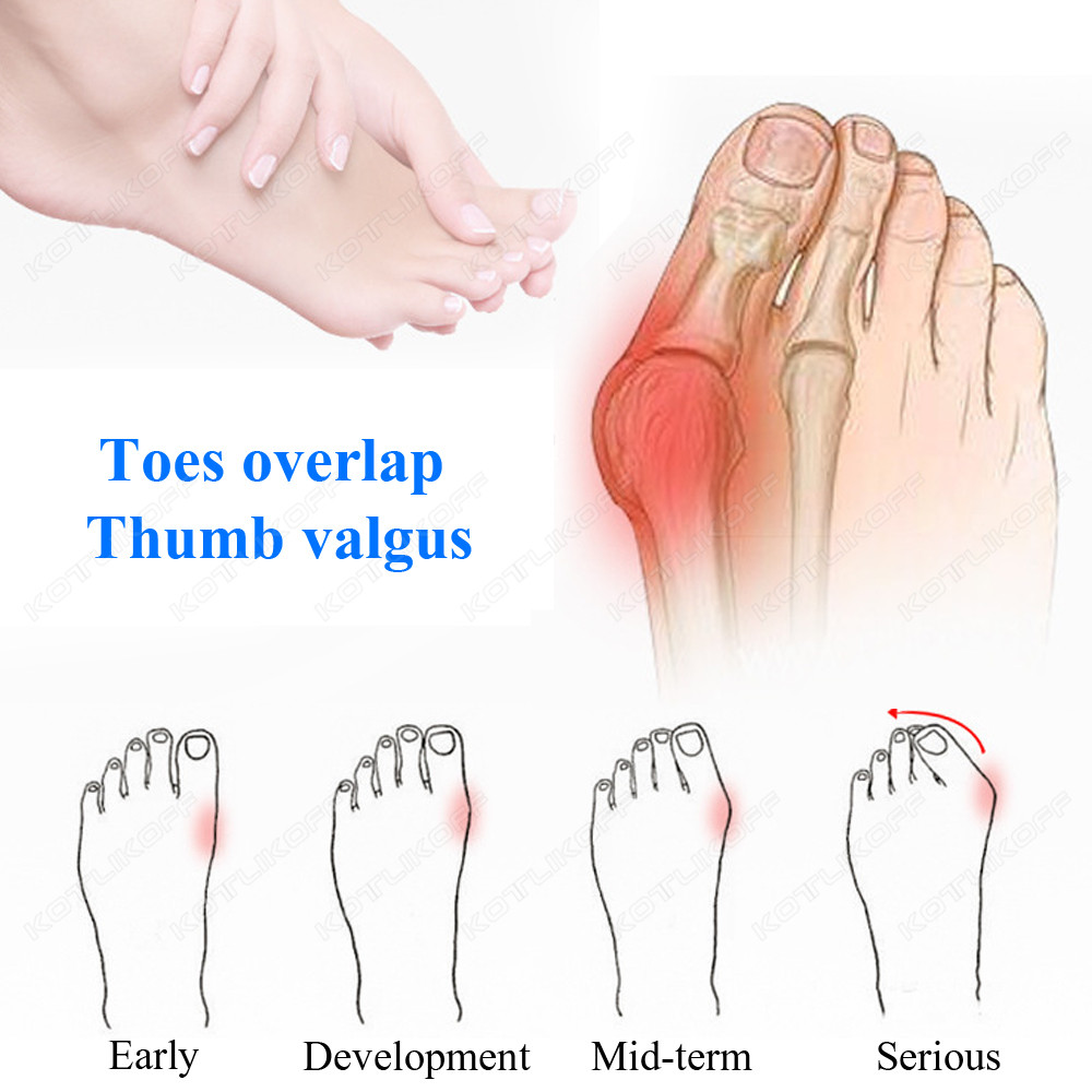 Toe Protective Toes Separator  - Toe Separator Silicon review and price